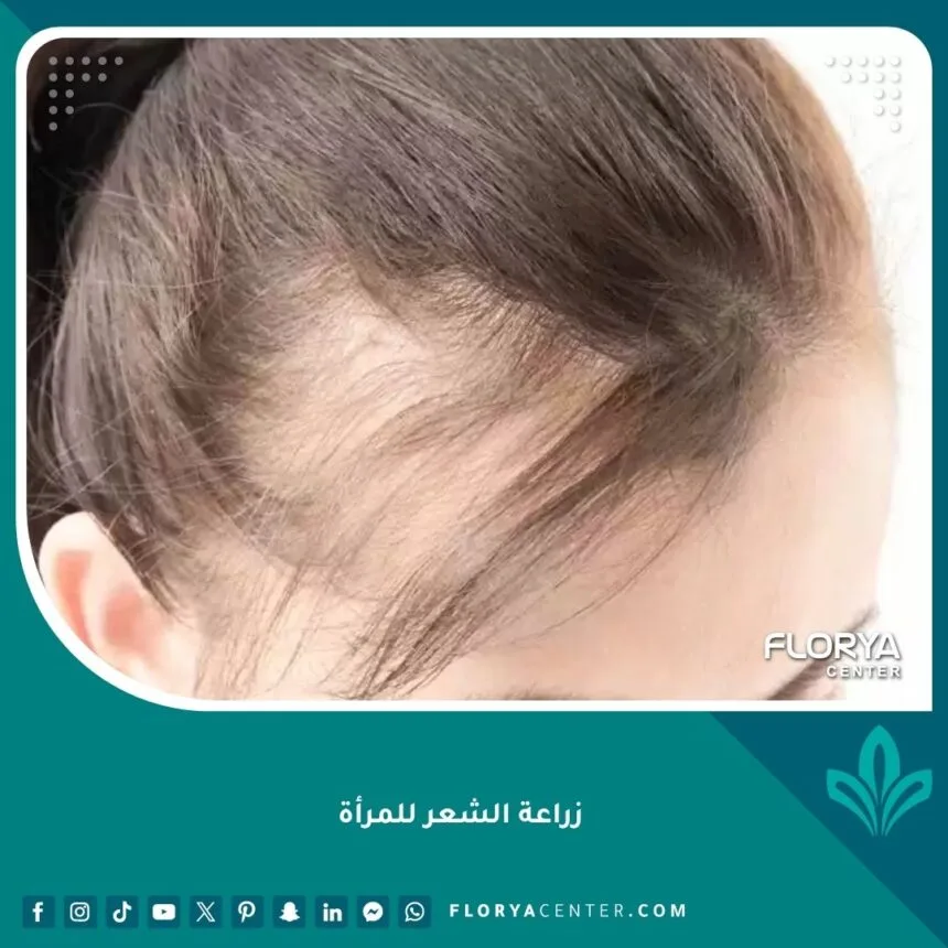 ألأولى لزراعة الشعر الطبيعي والتجميل - زراعة الشعر في الوسطى