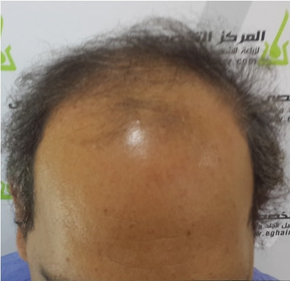 المركز التخصصى لزراعة الشعر وتجميل الجلد - زراعة الشعر في الجيزة