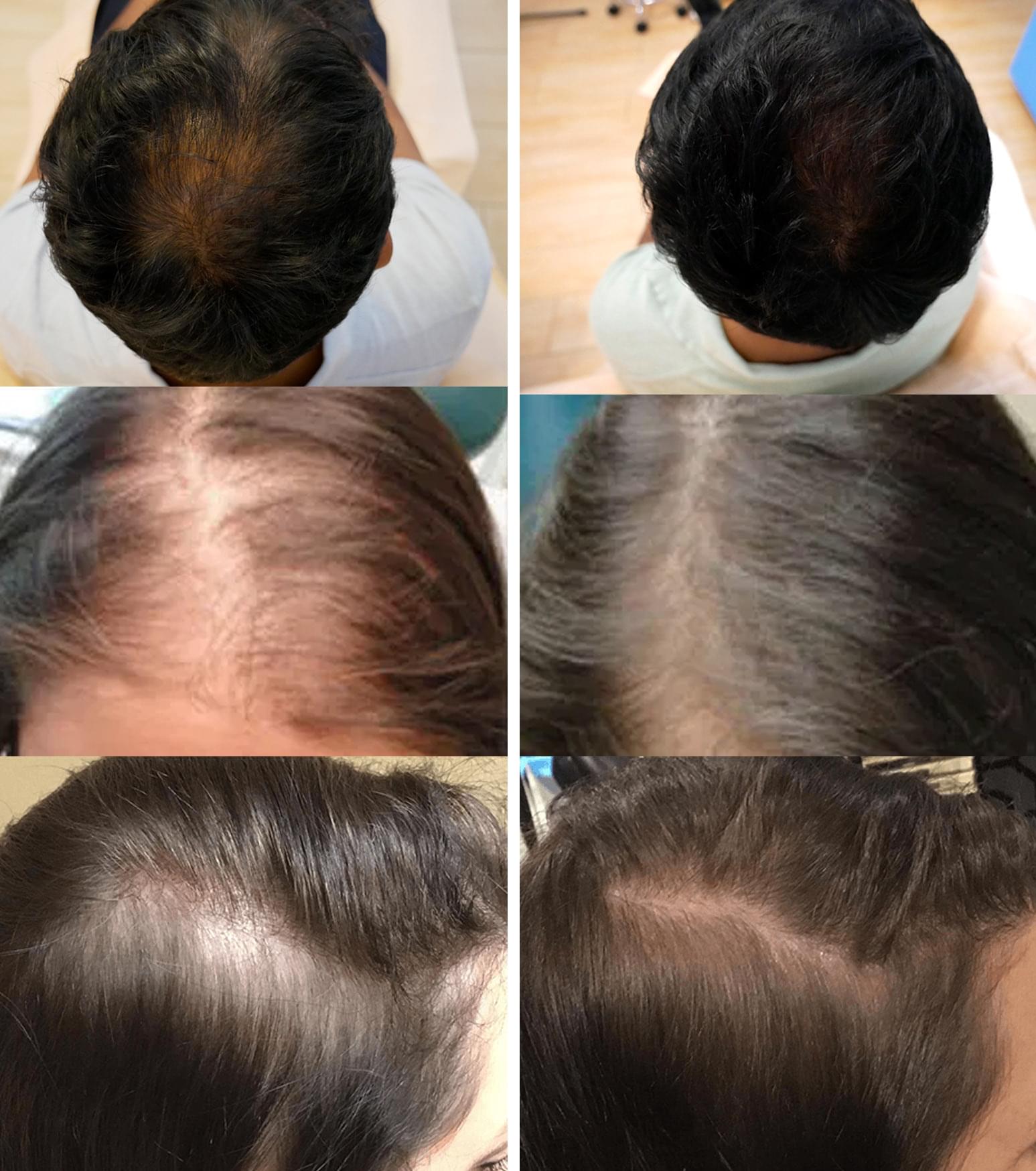 عيادة الاوائل لزراعة الشعر - زراعة الشعر في النجف