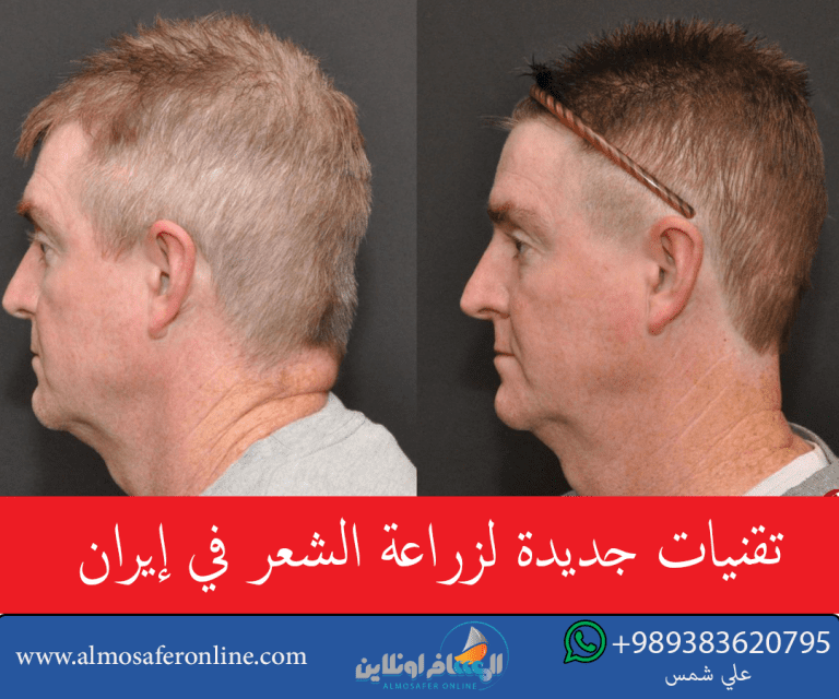 عيادات الاستاء التخصصية - زراعة الشعر في البحر الأحمر