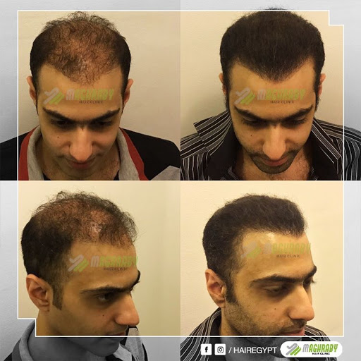 عيادات المغربي لزراعة الشعر في مصر HairEgypt - زراعة الشعر في الجيزة