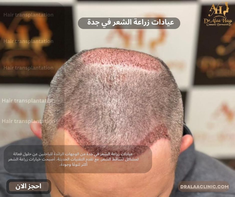 عيادات مكة الطبية والتجميلية - زراعة الشعر في عمّان