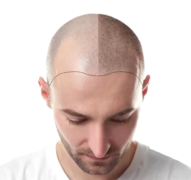 أيزوكير للعلاج الطبيعي - زراعة الشعر في كفر الشيخ