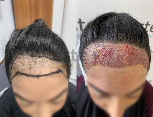 Best Hair Transplant Istanbul, Turkey, Men/Women Hair Restoration Turkey, Fue Hair Transplant Turkey - زراعة الشعر في مطروح