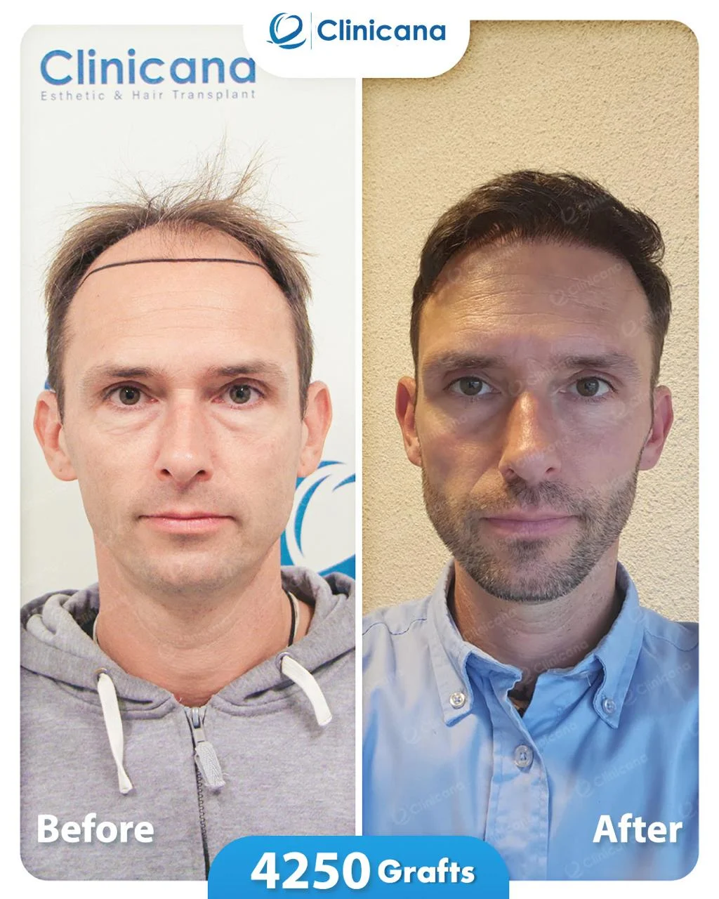 Clinicana Hair Transplant & Esthetic Surgeries - زراعة الشعر في مطروح