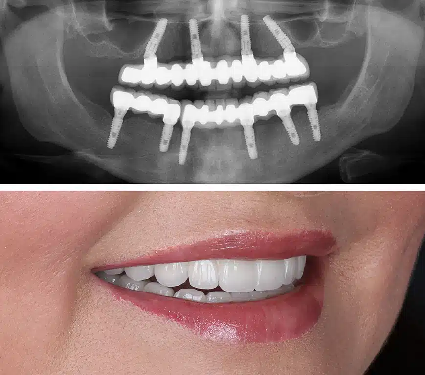 Dr. Eyad Sanyour Dental Implant and maxillofacial surgery clinic عياده الدكتور اياد سنيور لزراعه الأسنان وجراحه الفم والفكين - عيادات أسنان في الريان
