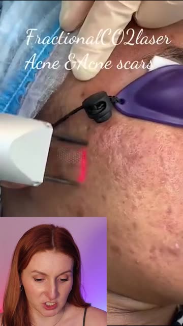 Dr. Snoor Aqrawi Aesthetic Laser - زراعة الشعر في دهوك