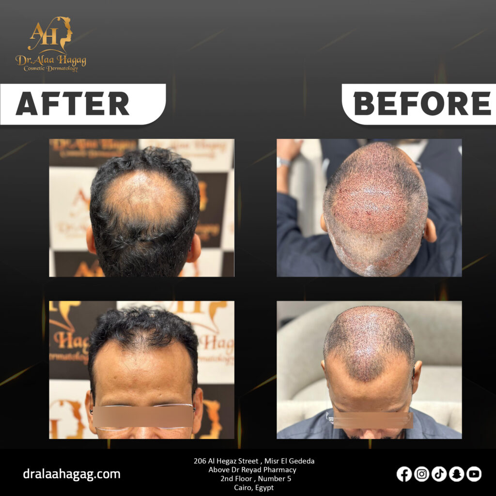 دينتال سيتي د.حازم حجاج - زراعة الشعر في قنا