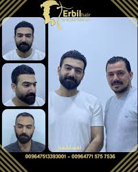 Erbil Hair Transplantaion - زراعة الشعر في أربيل والعراق - زراعة الشعر في أربيل