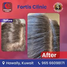 Fortis Hair clinic - زراعة الشعر في حولي