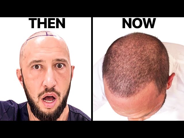 غازي مول للتسوق - زراعة الشعر في كركوك