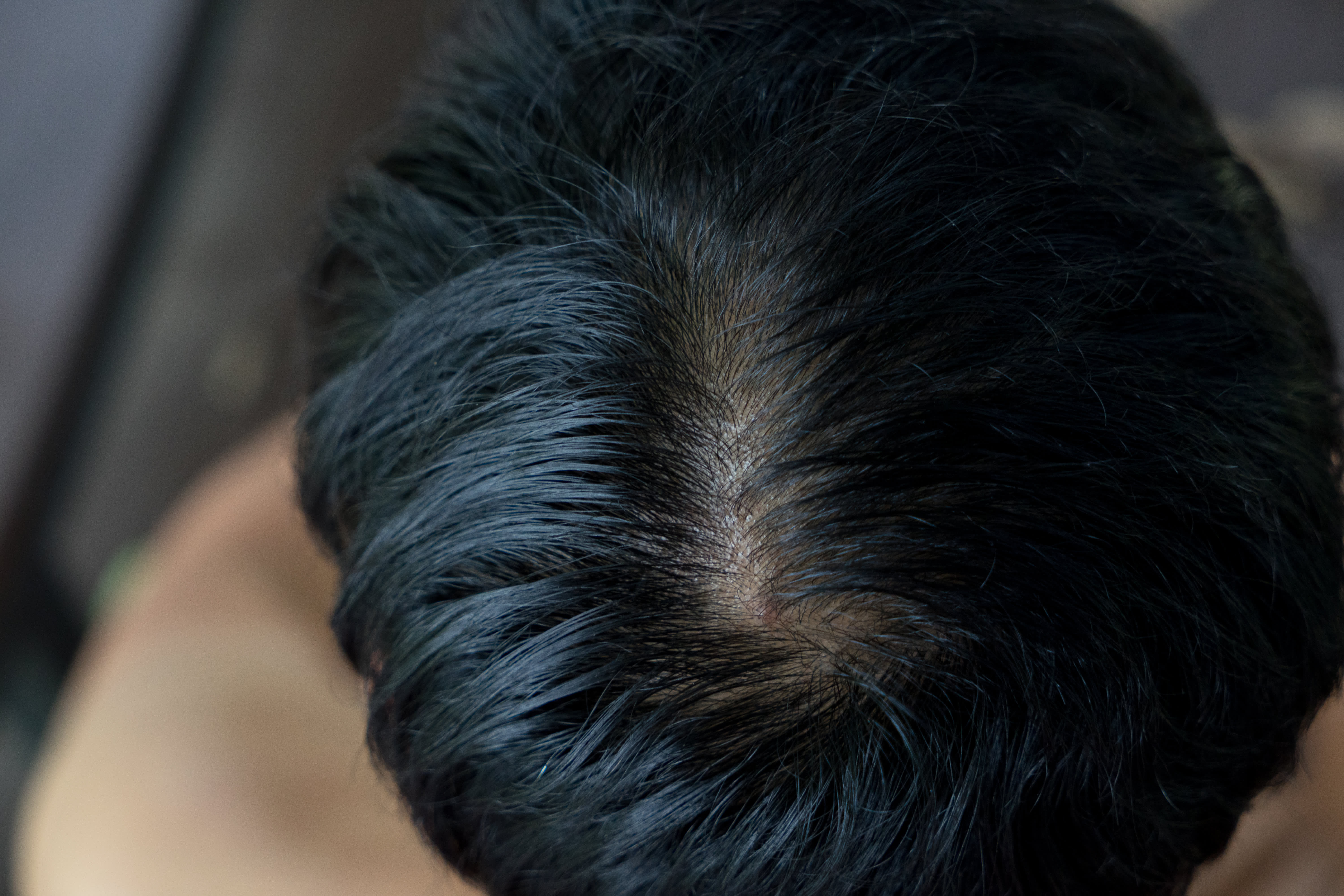 Gulf Gate Hair Fixing - زراعة الشعر في الأحمدي