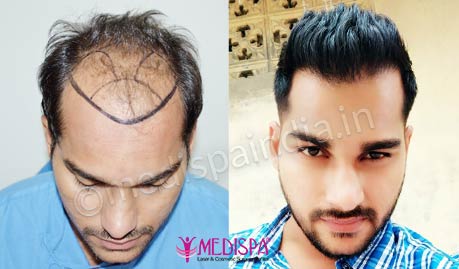 Hair clinic - زراعة الشعر في دبي