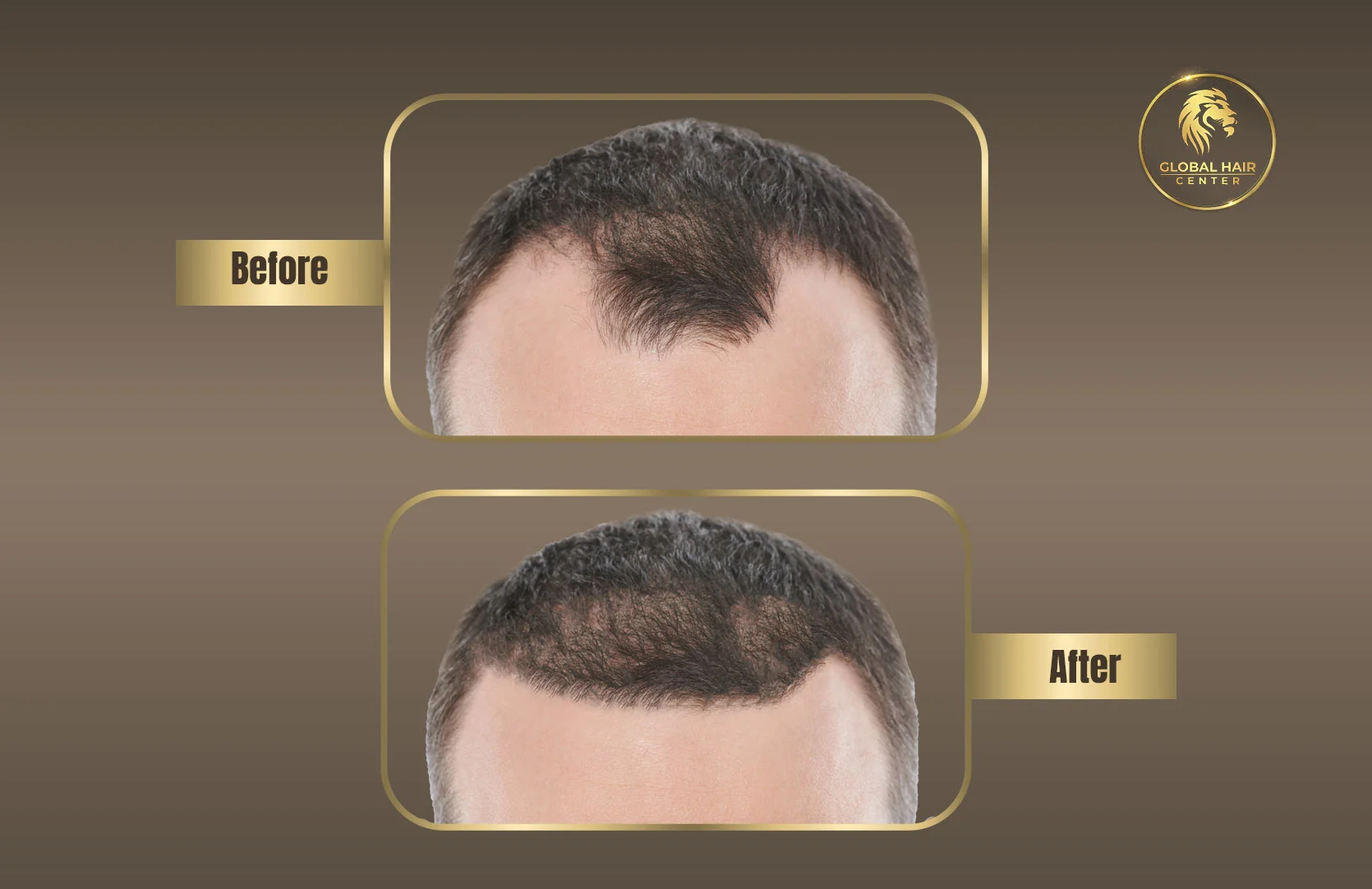 Hair Transplant in Dubai - Best Hair Transplantation Clinic - زراعة الشعر في دبي