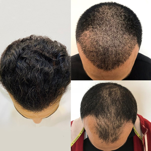 Hair Transplant Kuwait - Toronto Hair Institute - زراعة الشعر في مدينة الأحمدي