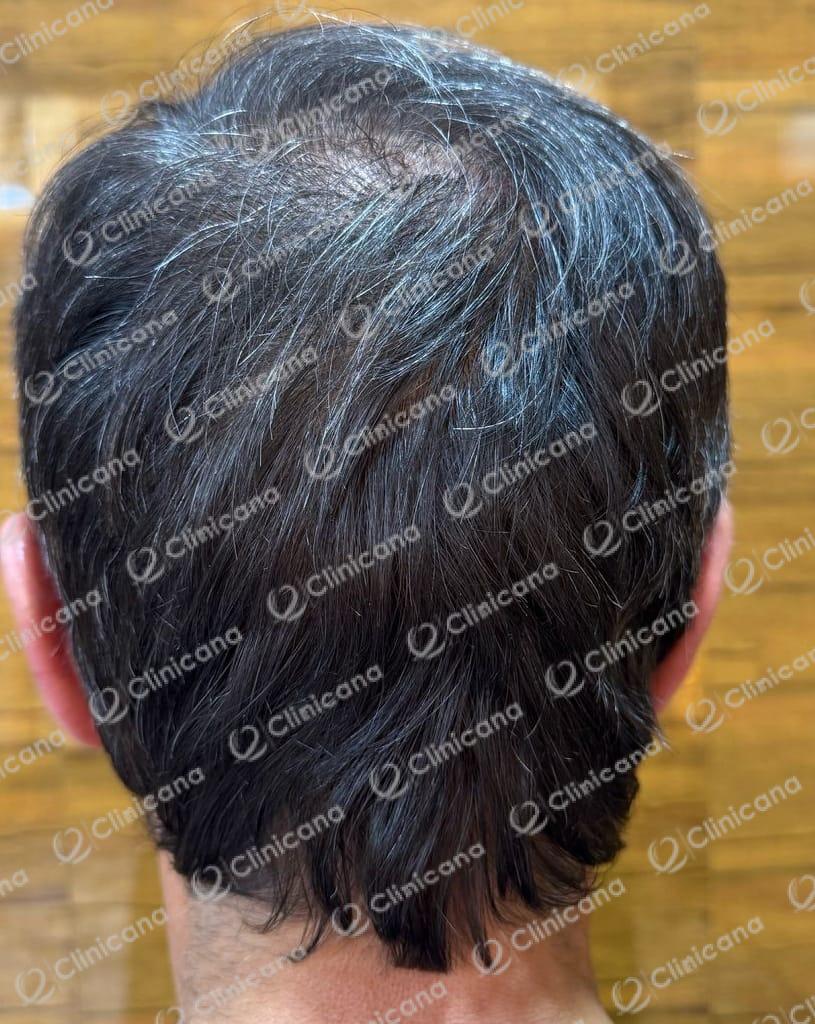 كلينيكا ژین - زراعة الشعر في دهوك