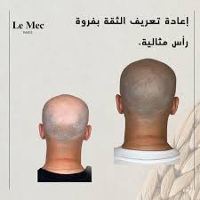 Le Mec Paris - زراعة الشعر في مدينة الكويت