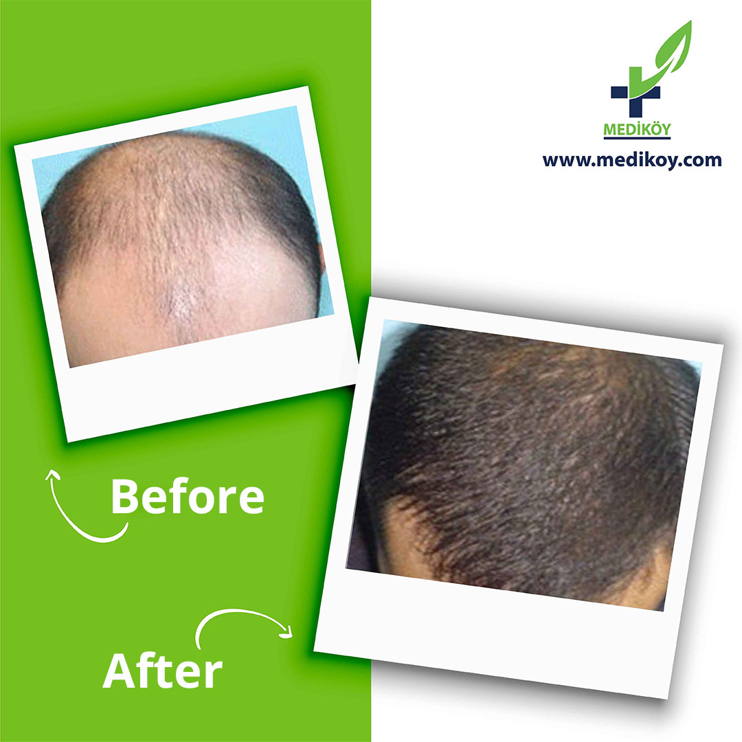 Medikoy for hair transplant|ميديكوي لزراعة الشعر في تركيا - زراعة الشعر في الشمال