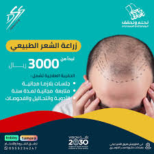 مجمع عيادات الدكتورة سحر الدوسري لزراعة الشعر وجراحة التجميل - زراعة الشعر في حقل
