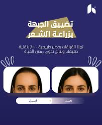 مجمع عيادات الحقيل الطبي لزراعة الشعر والتجميل بالبندرية - زراعة الشعر في الشرقية