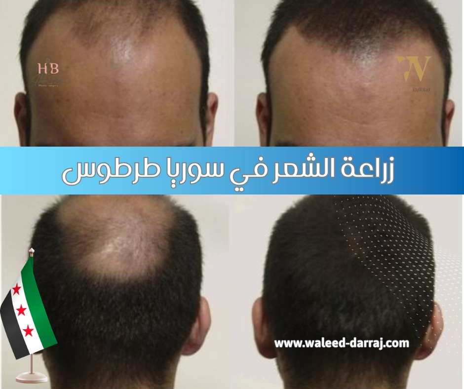 مركز الطاووس للتجميل و زراعة الشعر - زراعة الشعر في بغداد