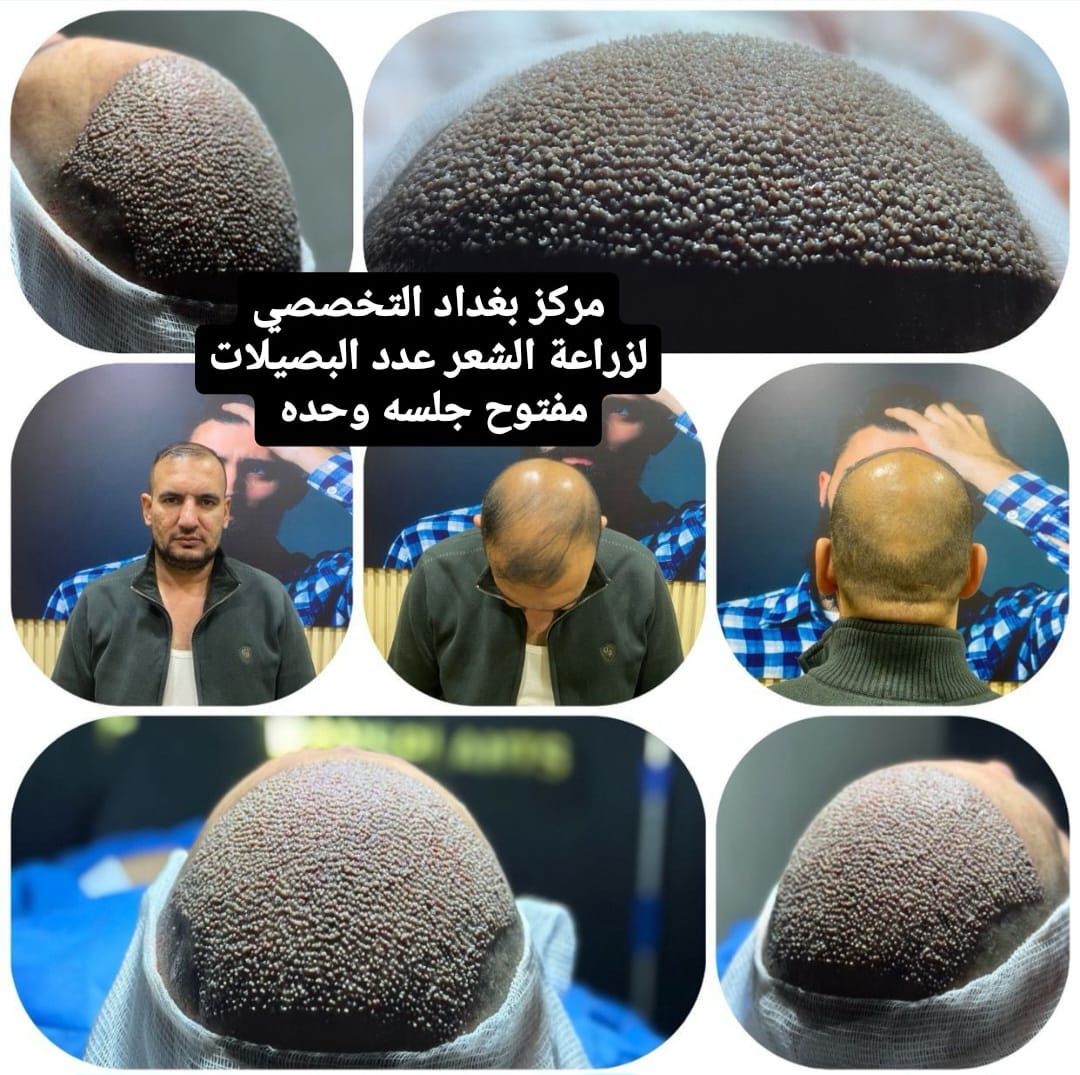 مركز بغداد التخصصي لزراعة الشعر - زراعة الشعر في بغداد