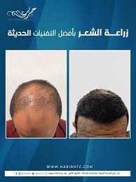 مركز حرير لزراعة الشعر - زراعة الشعر في العبدلي
