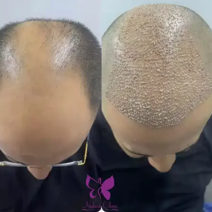 مركز نوارة للتجميل - زراعة الشعر في الفجيرة