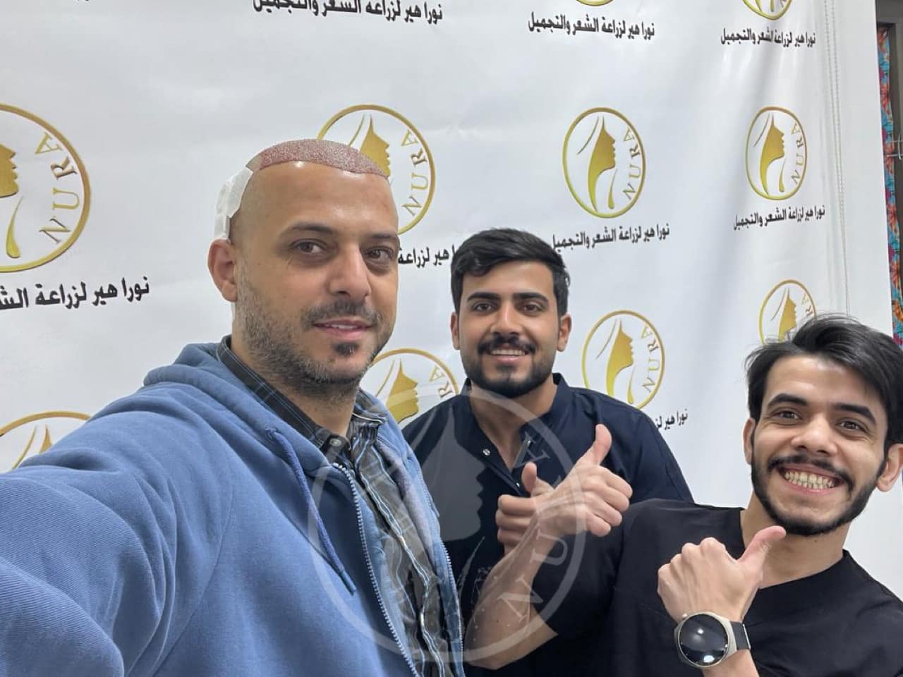 مركز نورا هير لزراعة الشعر - زراعة الشعر في بغداد