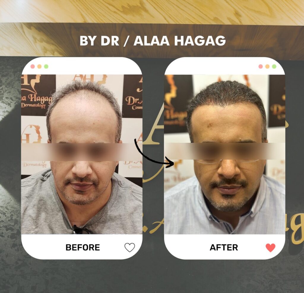 مركز تجميل الوجه - زرع شعر - زراعة الشعر في الجيزة