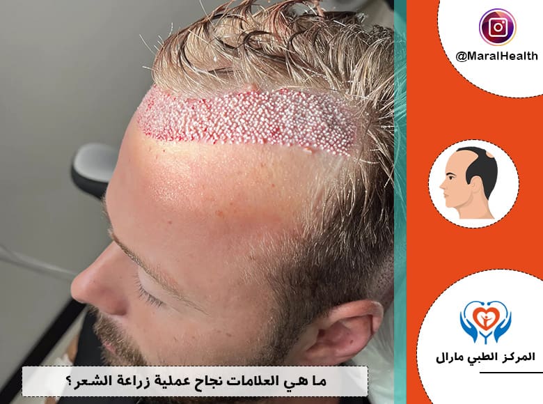 مرکز تجمیل و زراعة الشعر - زراعة الشعر في السليمانية