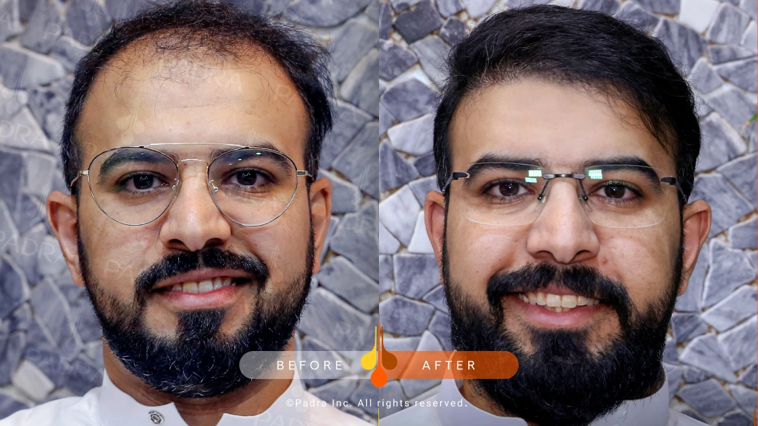 Padra Clinic - Hair Transplant & Aesthetics - زراعة الشعر في حولي
