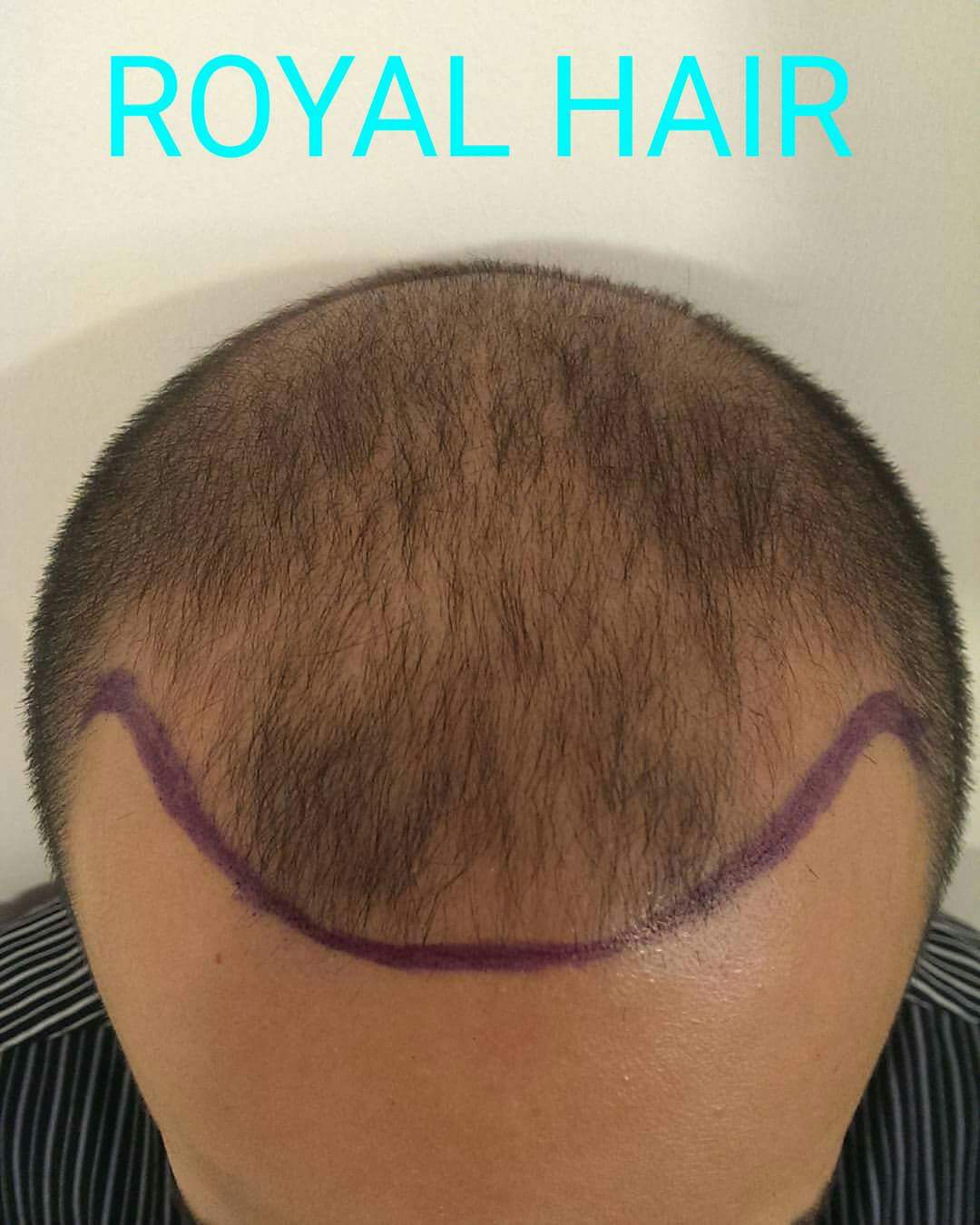 Royal Hair رويال هير لزراعة الشعر - زراعة الشعر في بغداد