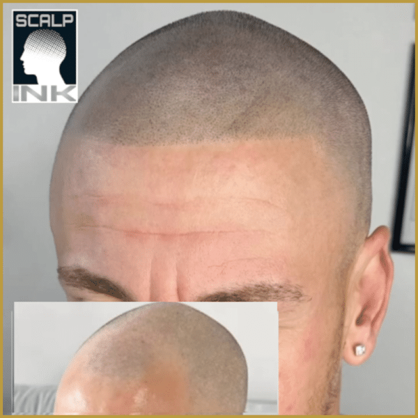 Scalp jo smp - زراعة الشعر في عمّان