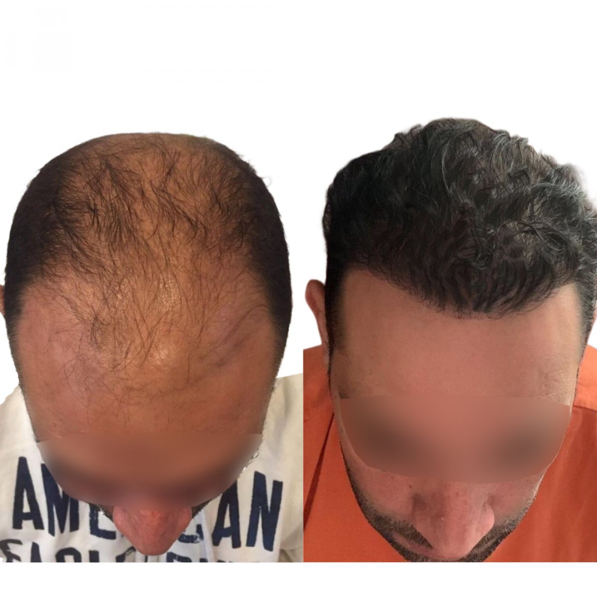 سنتر الهند للشعر الطبيعي - زراعة الشعر في بغداد
