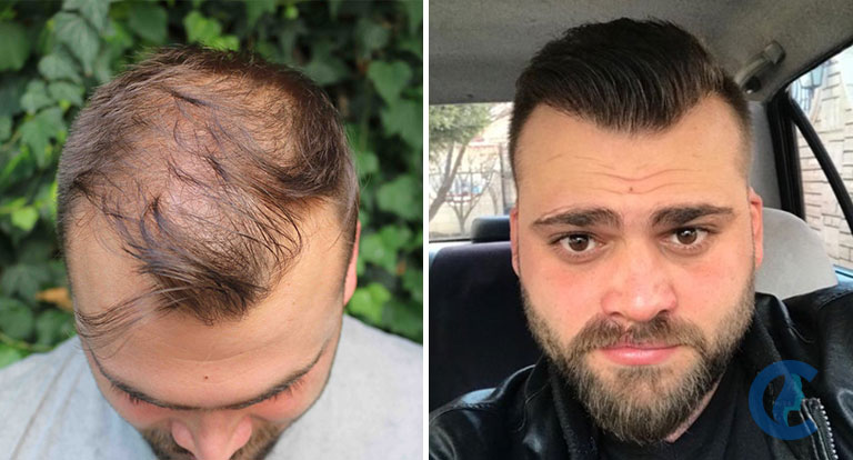 Turkey Hair Clinic. - Hair restoration - زراعة الشعر في الجيزة