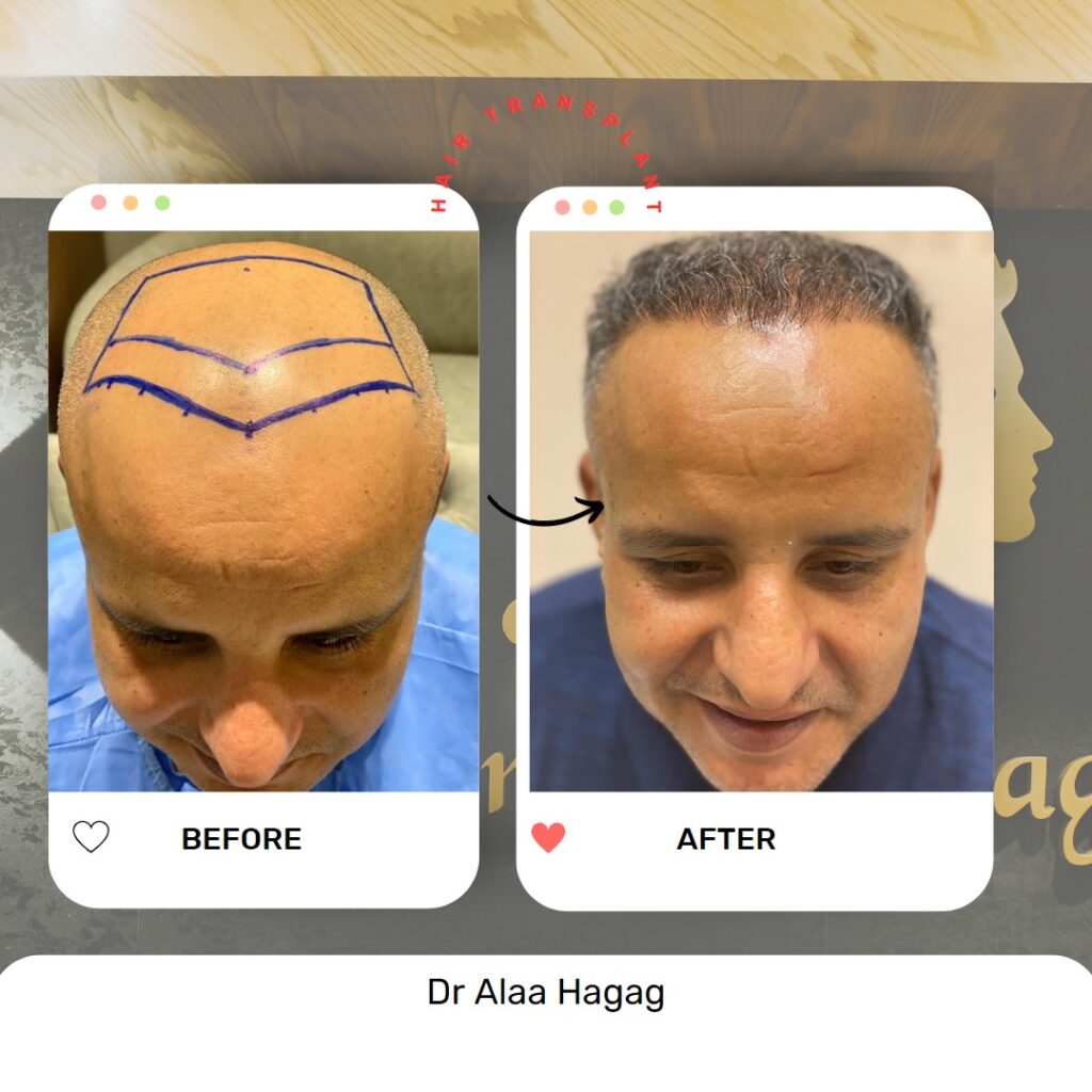 زراعة الشعر دكتور شكيلا تاجيك زادة - زراعة الشعر في البصرة
