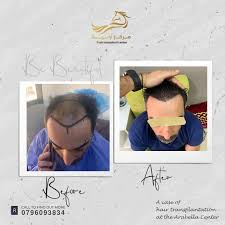 زراعة الشعر في اربد _ مركز أرابيلا - زراعة الشعر في إربد