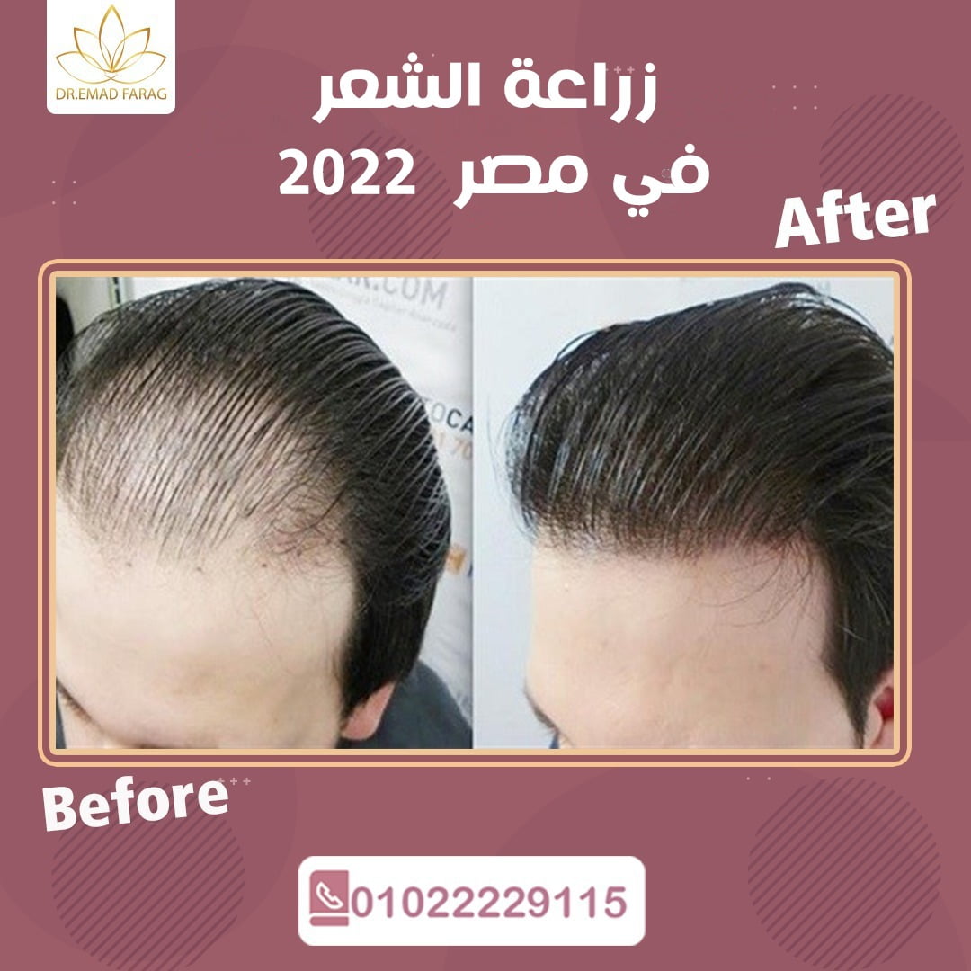 زراعة الشعر في مصر - زراعة الشعر في القاهرة