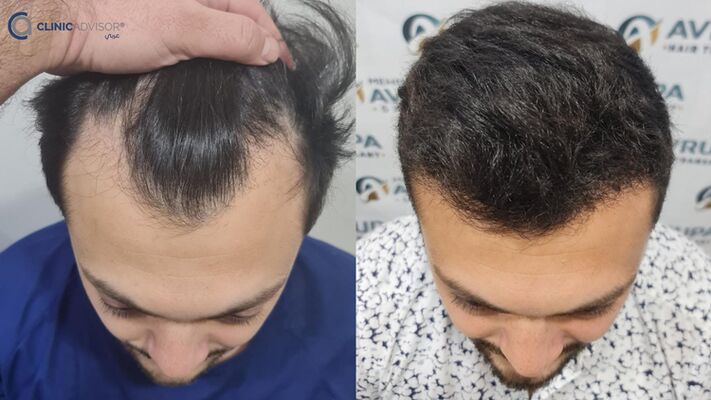 زراعة الشعر في تركيا - اسطنبول - زراعة الشعر في الجبيل