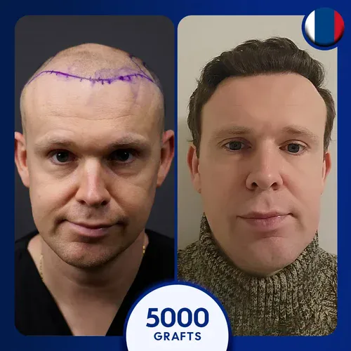 زراعة الشعر في تركيا اسطنبول - INF.Clinic Turkey - زراعة الشعر في الشرقية