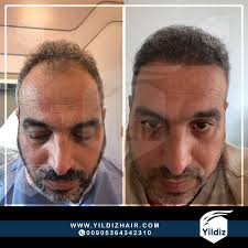 زراعة الشعر في تركيا - YildizHair - لزراعة الشعر في اسطنبول - زراعة الشعر في الشرقية