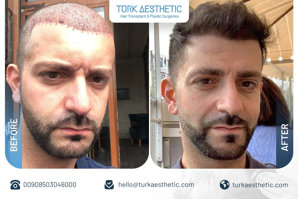 زراعة شعر. الحية. کاشت مو و ریش.hair transplantation - زراعة الشعر في شمال الباطنة